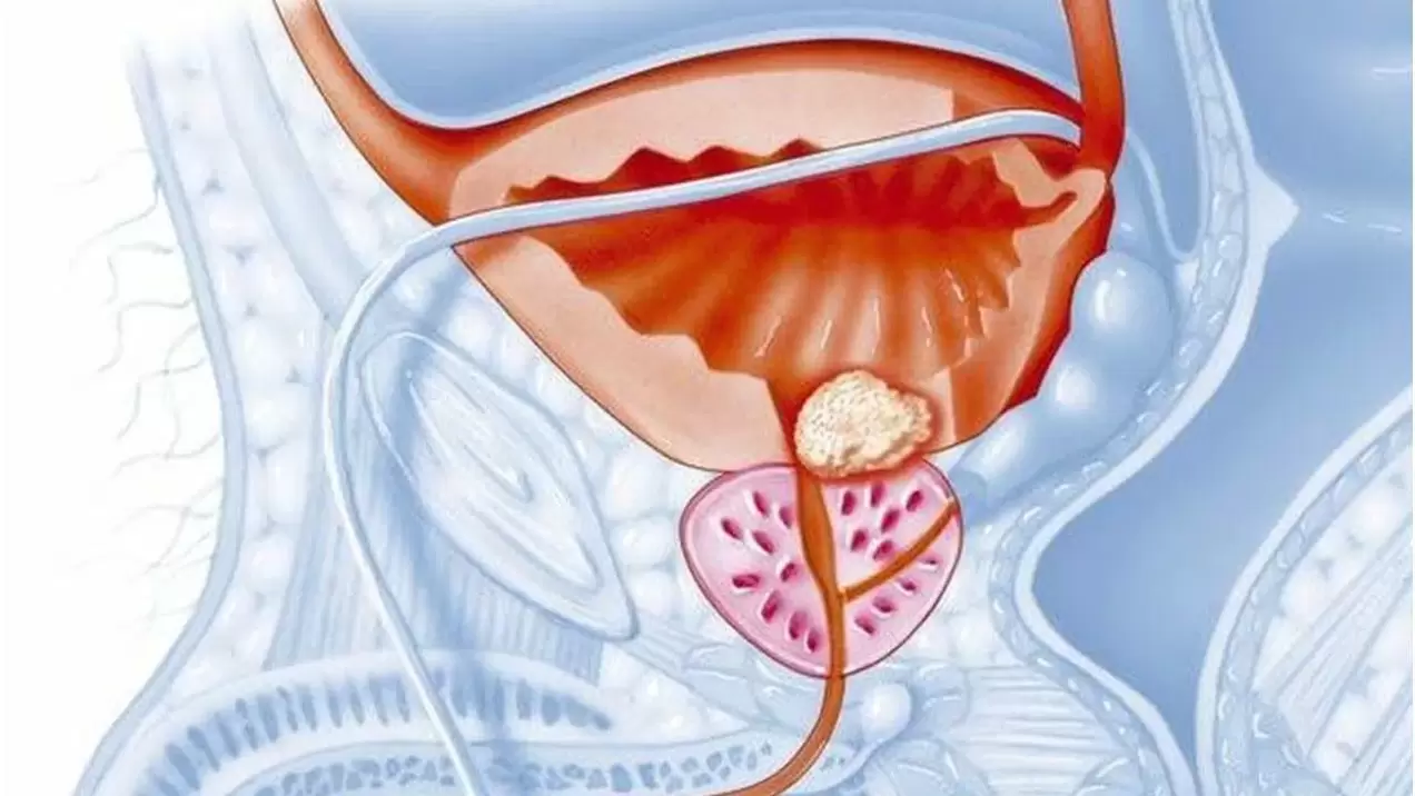 bolezni prostate pri moških